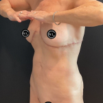 Abdominoplasty Before & After Patient #16856