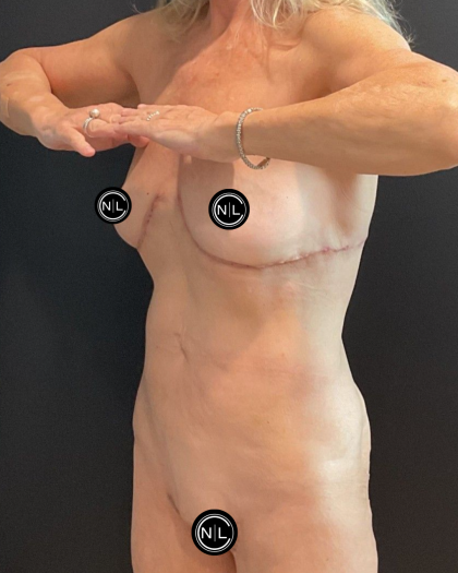 Abdominoplasty Before & After Patient #16856