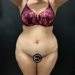 Abdominoplasty Before & After Patient #16934