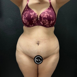 Abdominoplasty Before & After Patient #16934