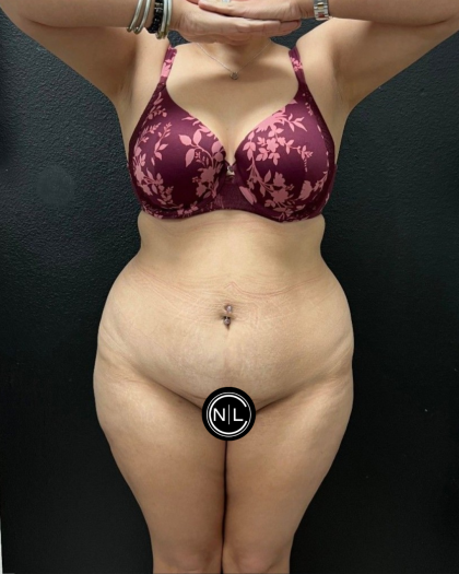 Abdominoplasty Before & After Patient #16934