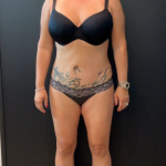 Weight Loss Before & After Patient #16939