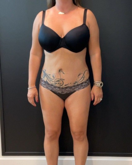 Weight Loss Before & After Patient #16939