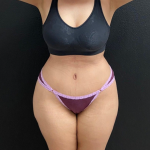Abdominoplasty Before & After Patient #16934
