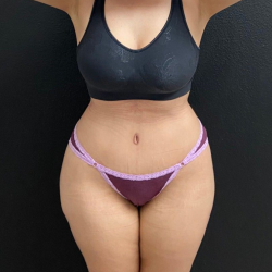 Abdominoplasty Before & After Patient #16934