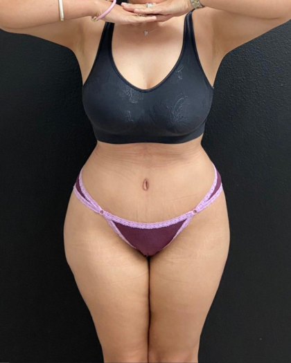 Abdominoplasty Before & After Patient #16934