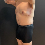 Chest Lift Before & After Patient #16938