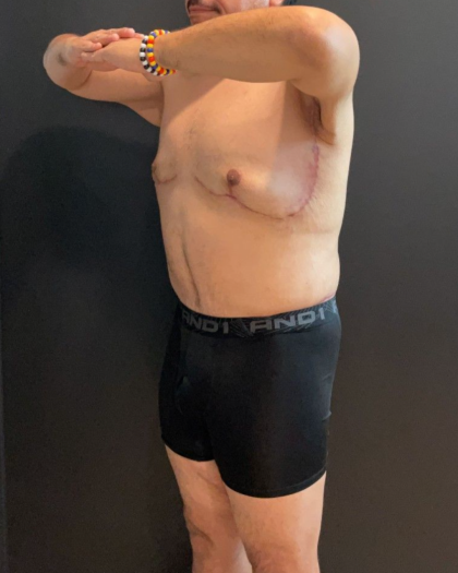 Chest Lift Before & After Patient #16938