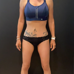 Weight Loss Before & After Patient #16939