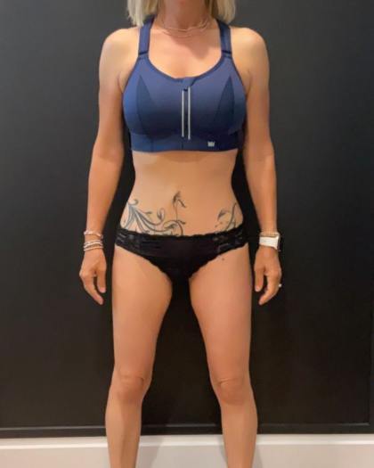 Weight Loss Before & After Patient #16939