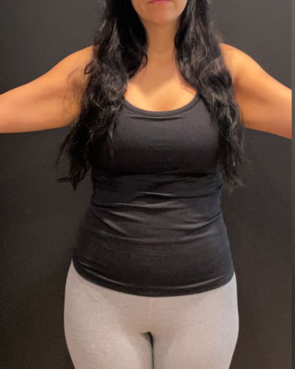 Weight Loss Before & After Patient #16940