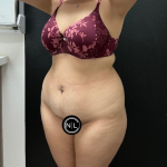 Abdominoplasty Before & After Patient #16934