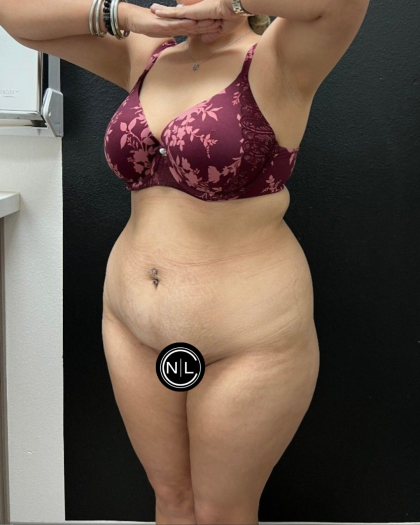 Abdominoplasty Before & After Patient #16934