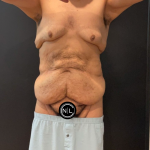 Abdominoplasty Before & After Patient #16935