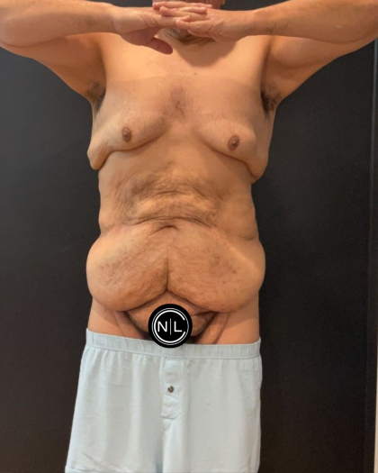 Abdominoplasty Before & After Patient #16935