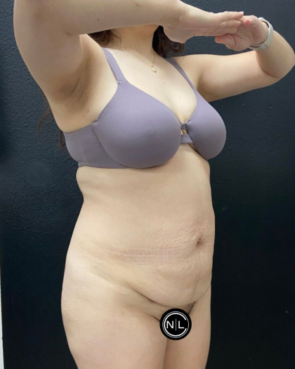 Abdominoplasty Before & After Patient #16933