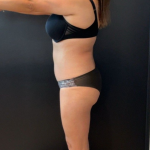 Weight Loss Before & After Patient #16939