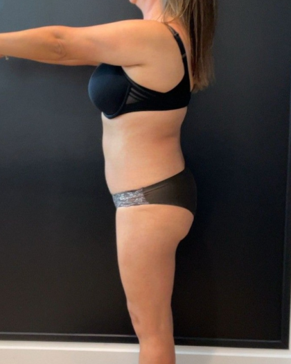 Weight Loss Before & After Patient #16939