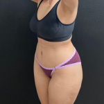 Abdominoplasty Before & After Patient #16934