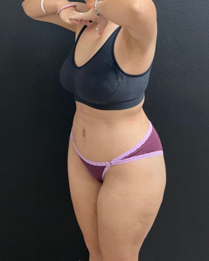 Abdominoplasty Before & After Patient #16934