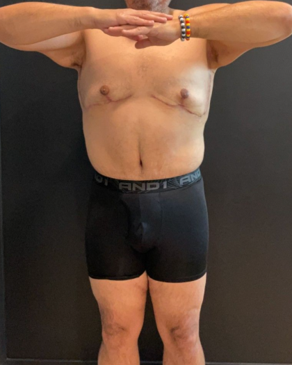 Abdominoplasty Before & After Patient #16935