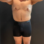 Chest Lift Before & After Patient #16938