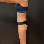 Weight Loss Before & After Patient #16939