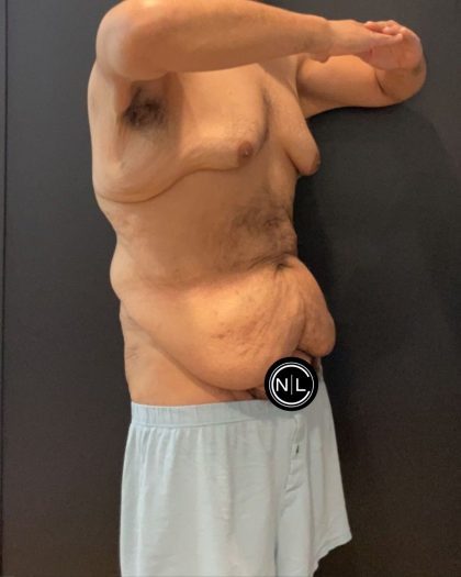 Abdominoplasty Before & After Patient #16935