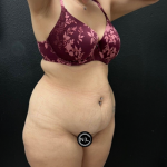 Abdominoplasty Before & After Patient #16934