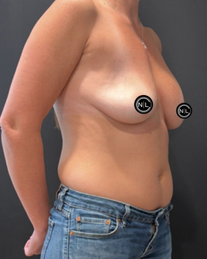 Breast Augmentation Before & After Patient #16937