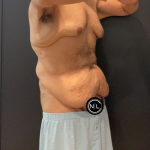 Chest Lift Before & After Patient #16938