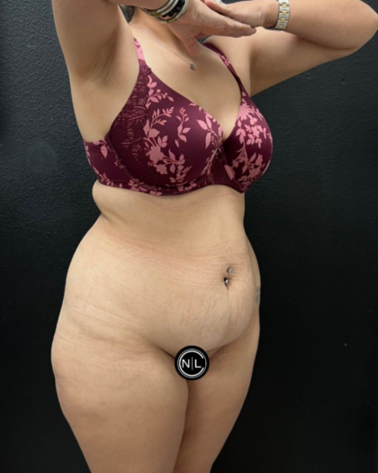 Abdominoplasty Before & After Patient #16934