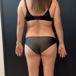 Weight Loss Before & After Patient #16939