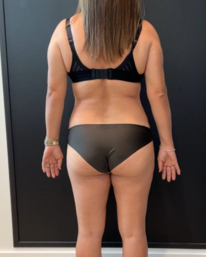 Weight Loss Before & After Patient #16939