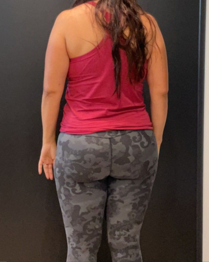 Weight Loss Before & After Patient #16940
