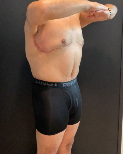 Abdominoplasty Before & After Patient #16935