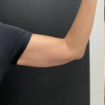 Brachioplasty Before & After Patient #16936