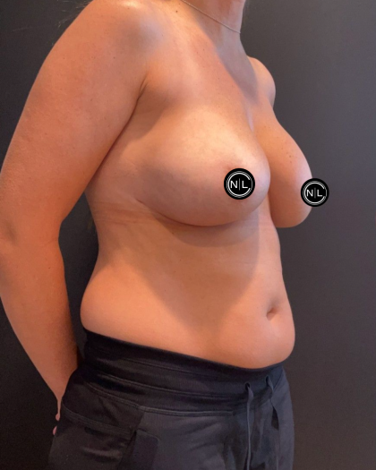 Breast Augmentation Before & After Patient #16937