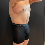 Chest Lift Before & After Patient #16938