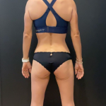 Weight Loss Before & After Patient #16939