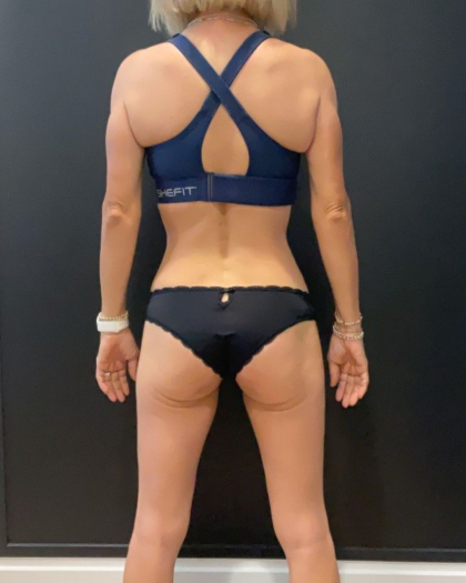 Weight Loss Before & After Patient #16939