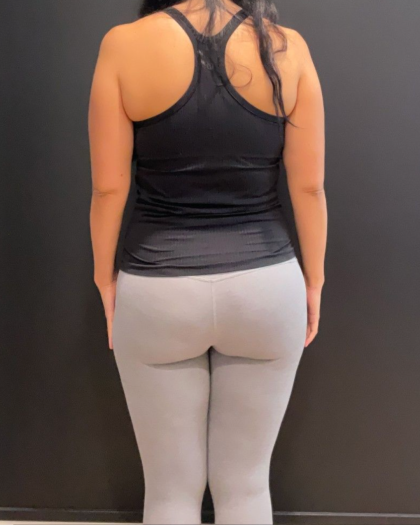 Weight Loss Before & After Patient #16940
