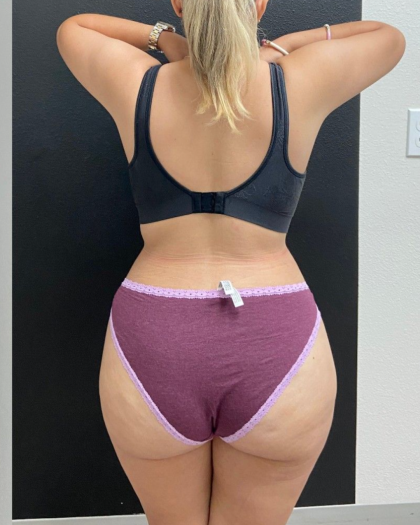 Abdominoplasty Before & After Patient #16934