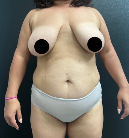 Breast Augmentation with Lift Before & After Patient #17073