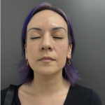 CO2 Laser Before & After Patient #17075