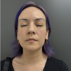 CO2 Laser Before & After Patient #17075