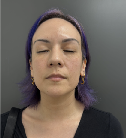 CO2 Laser Before & After Patient #17075