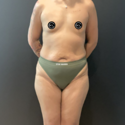 Mommy Makeover Before & After Patient #17077