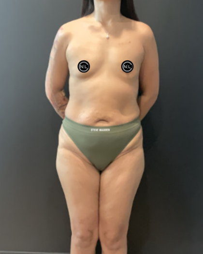 Mommy Makeover Before & After Patient #17077