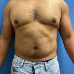Liposuction Before & After Patient #17076